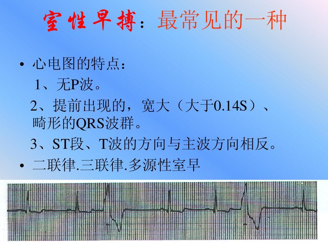 什么是异常q波_心电图异常q波_心电图q波异常能恢复吗